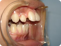 ワイヤー矯正治療前