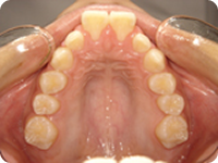 ワイヤー矯正治療前