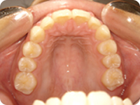 ワイヤー矯正治療前