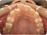 ワイヤー矯正治療前