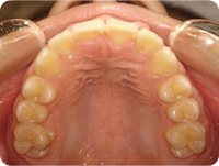 ワイヤー矯正治療後